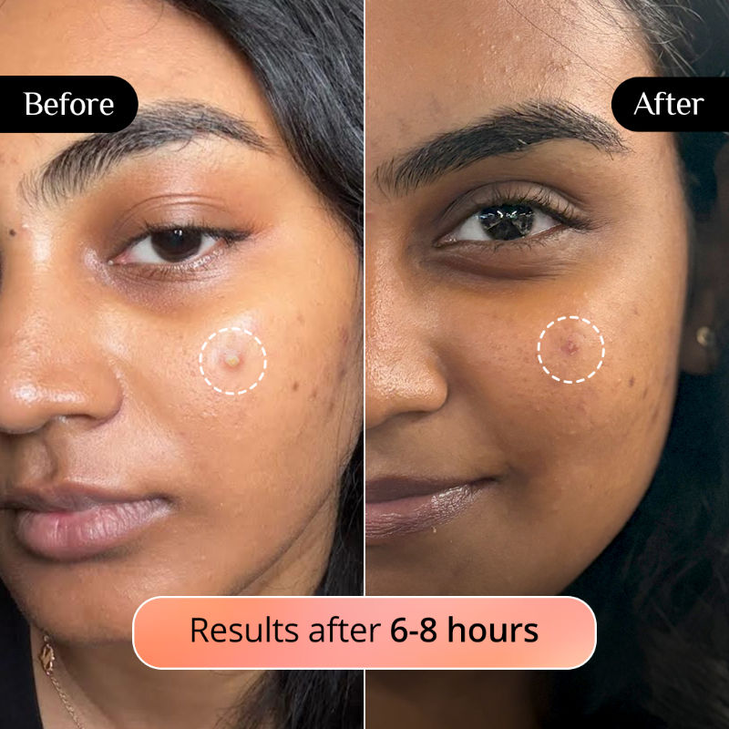 Carmesi Pimple Patch for Acne, 72 Hydrocolloid and Salicylic Acid Patches, For All Skin Types