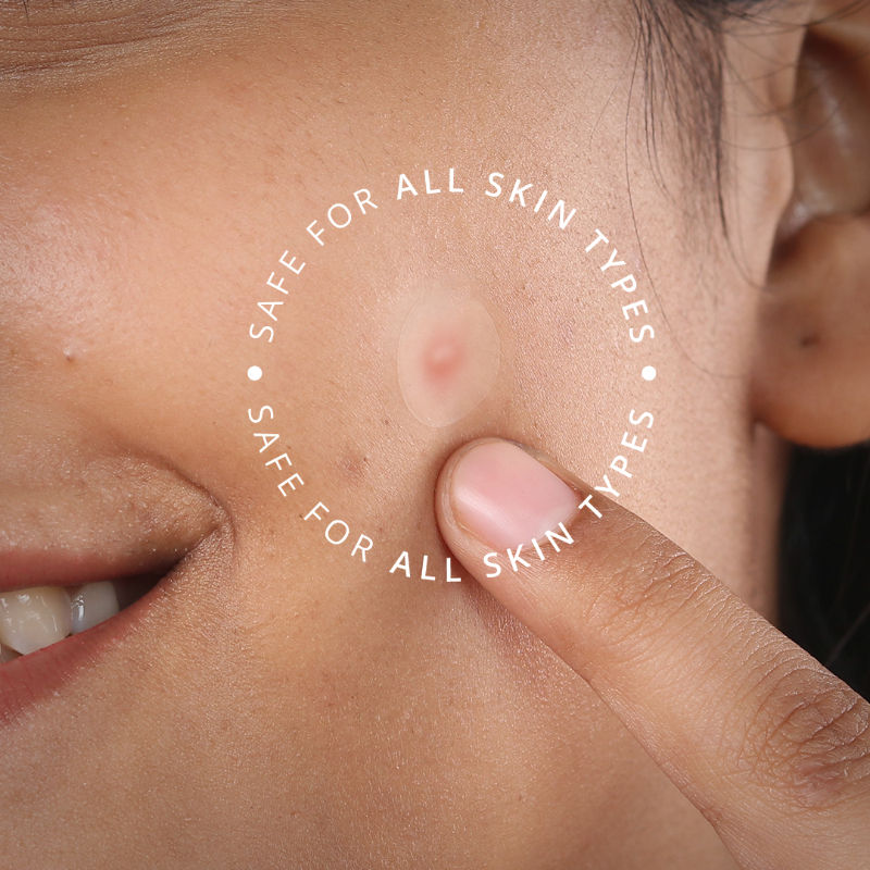 Carmesi Pimple Patch for Acne, 72 Hydrocolloid and Salicylic Acid Patches, For All Skin Types