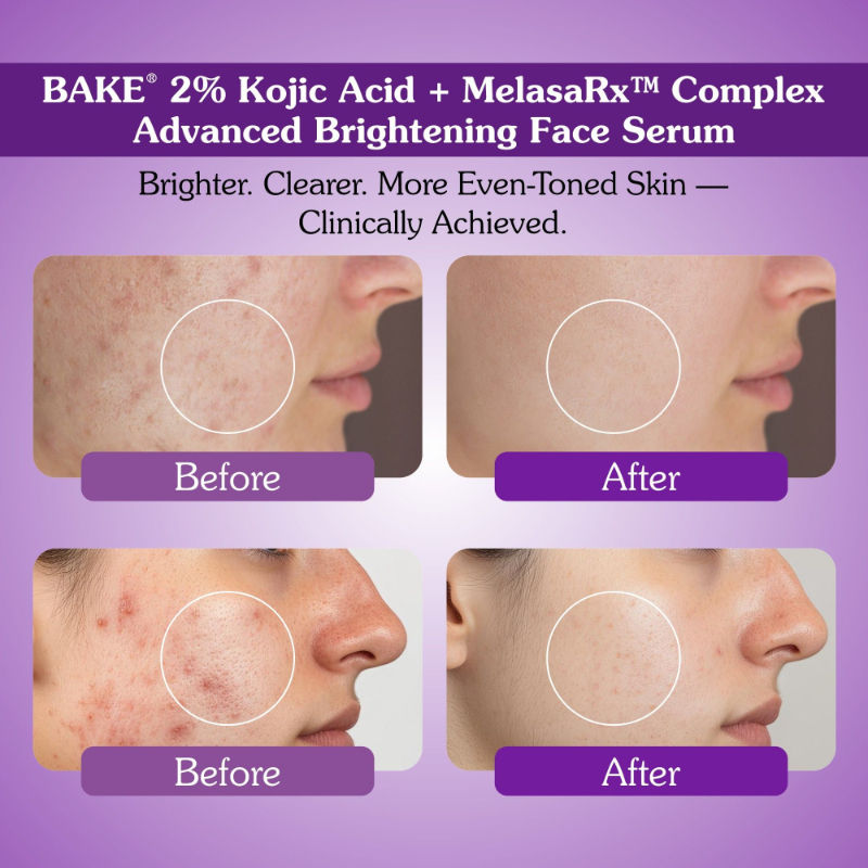 Bake 2% Kojic Acid Face Serum With Niacinamide For Pigmentation, Dark Spots & Uneven Skin Tone