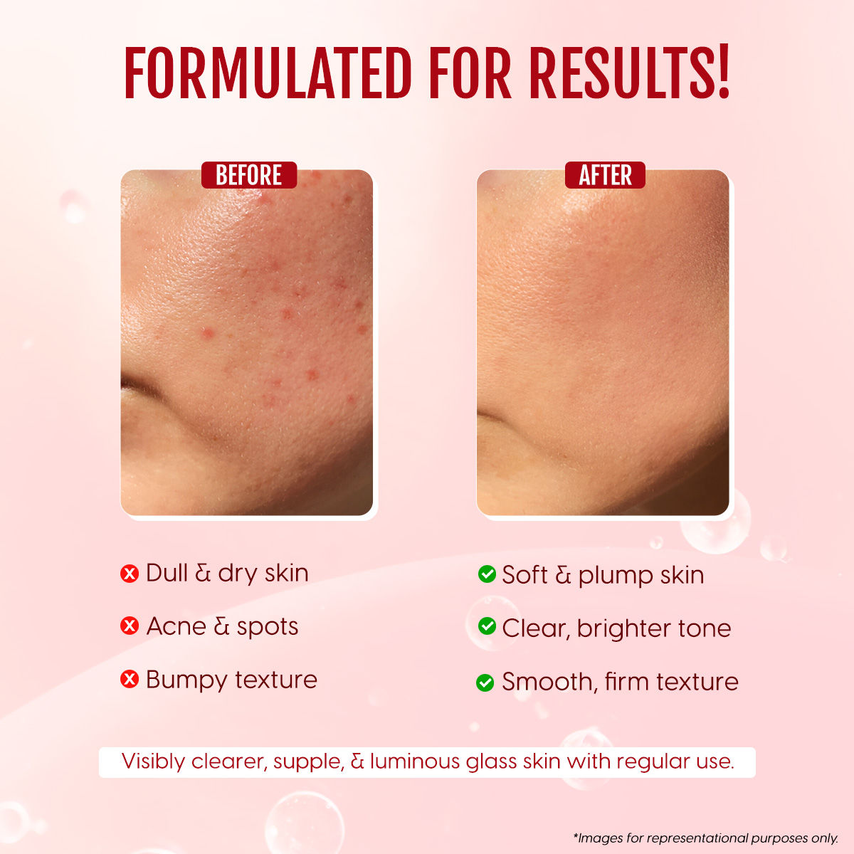 Matra Rice Ceramide Serum Barrier Repair With Niacinamide & Ha For Skin Brightening, Acne Spots